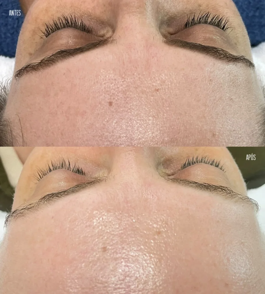 Antes e depois do tratamento Renove C